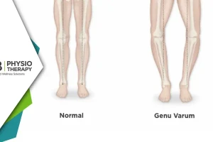 Genu Varum In Kids | A Physiotherapy Approach For Better Health.