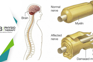 Guillain-barré Syndrome | Restoring Muscle Strength And Joint Functions By Physiotherapy