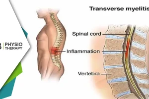 Transverse Myelitis | Managing Muscle Weakness And Regaining Mobility Through Physiotherapy