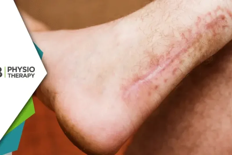 Achilles Tendon Rupture | Essential Role Of Postoperative Physiotherapy For Restoring Mobility