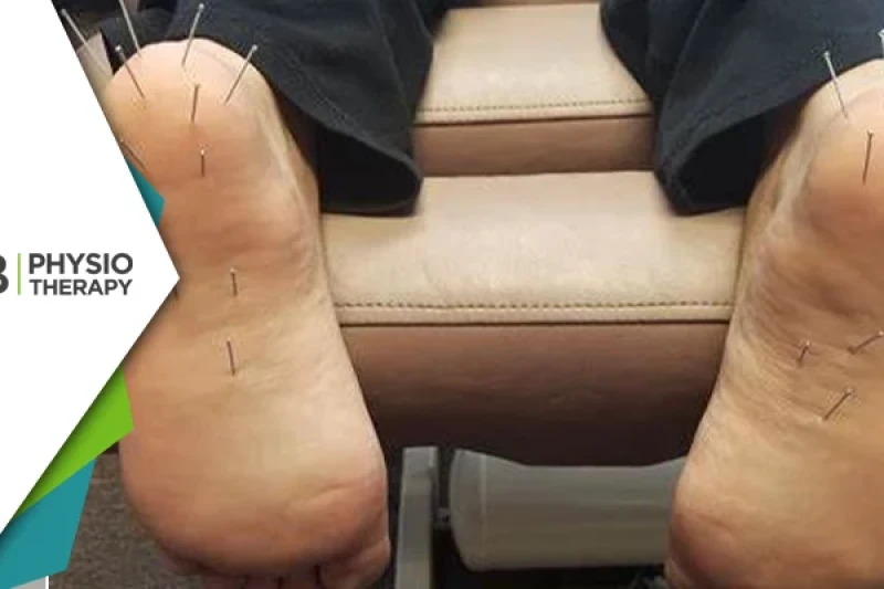 Dry Needling For Plantar Fasciitis | How It Can Help In The Management Of Heel Pain?