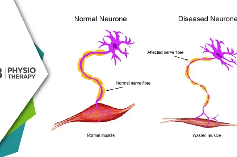 Empowering Lives | The Crucial Role Of Physiotherapy In Managing Motor Neuron Disease (mnd)