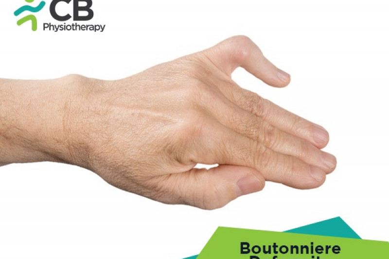 boutonniere-deformity.webp