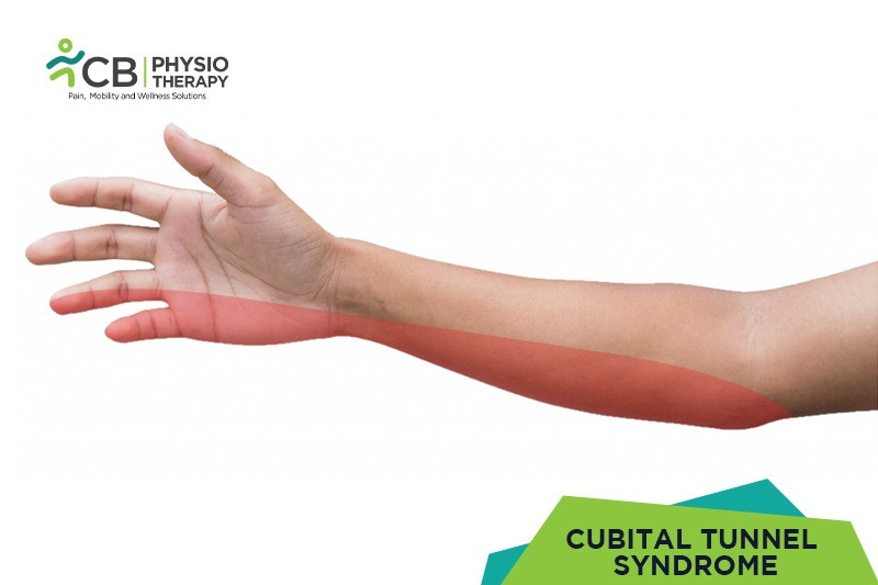 cubital-tunnel-syndrome.webp