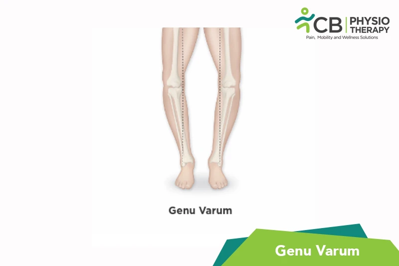 genu-varum.webp