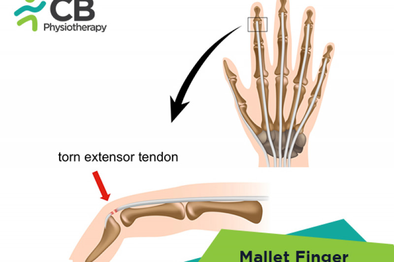 mallet-finger.webp