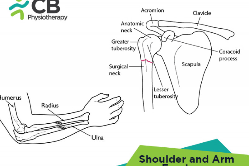 shoulder-and-arm-fractures.webp