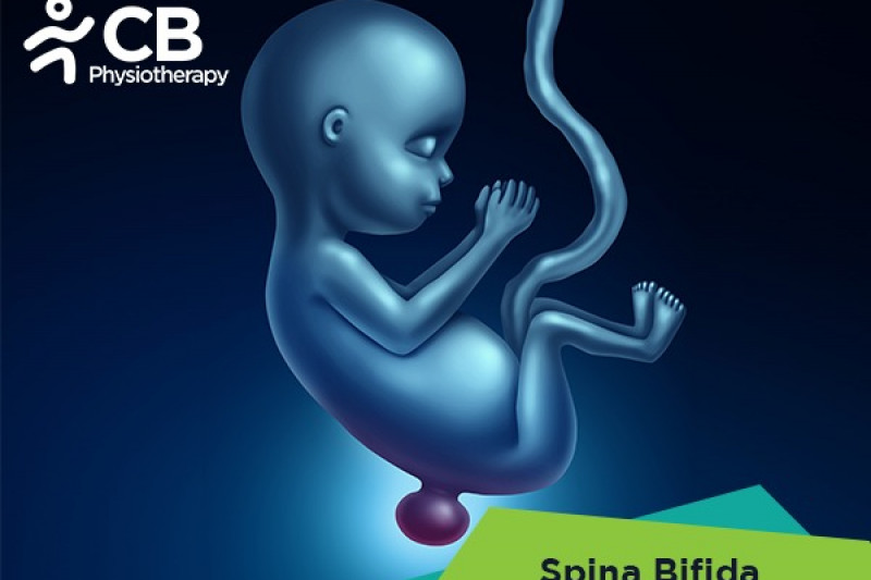 spina-bifida.webp