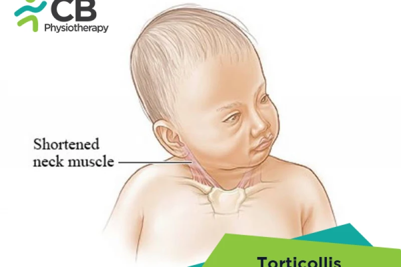 torticollis.webp