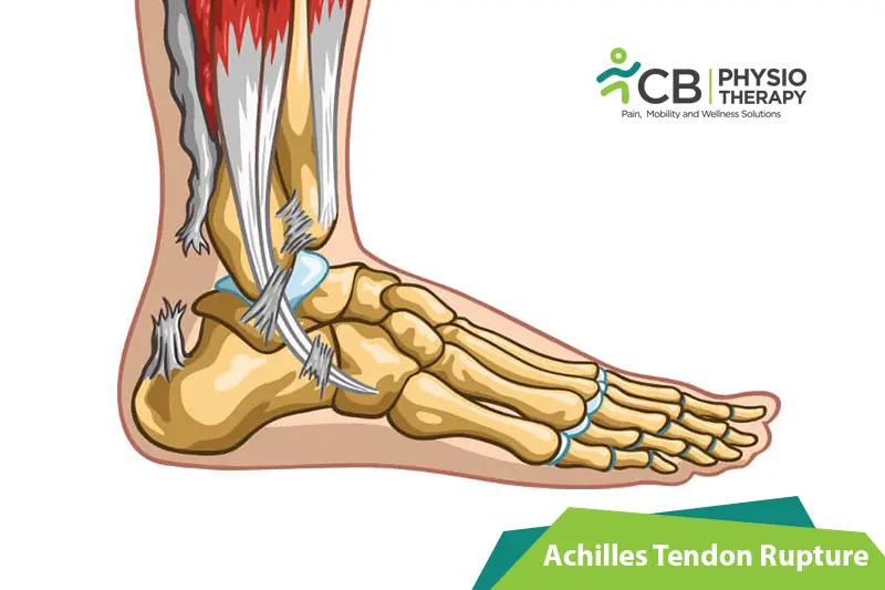 Achilles Tendon Rupture