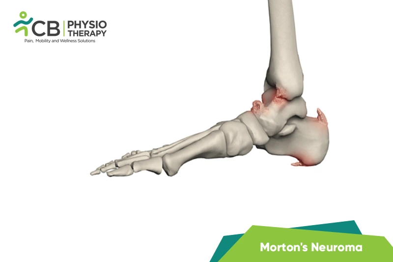 Ankle Bone Spur