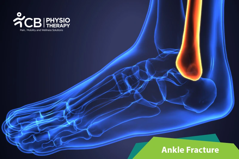 Ankle Fracture