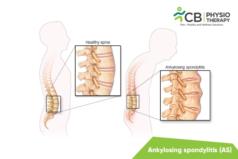 Ankylosing Spondylitis (as)