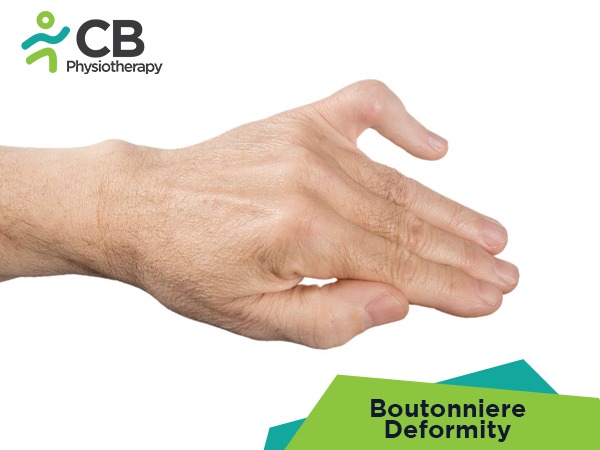 Boutonniere Deformity
