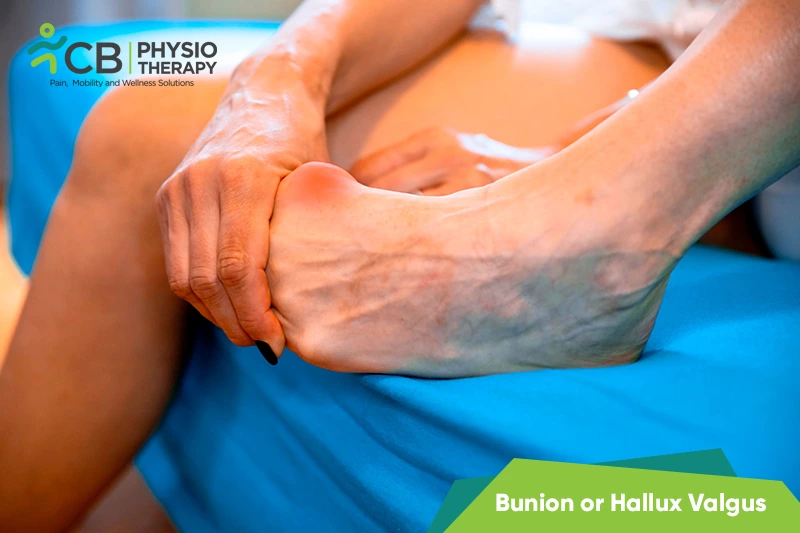 Bunion Or Hallux Valgus