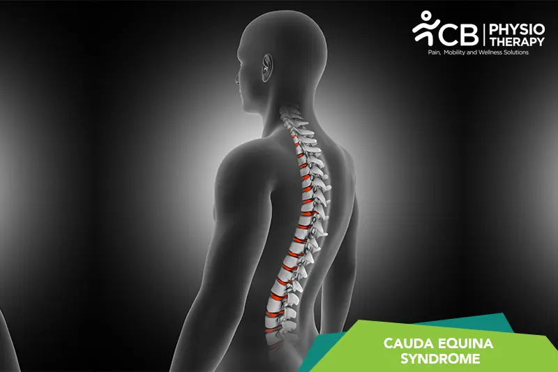 Cauda Equina Syndrome