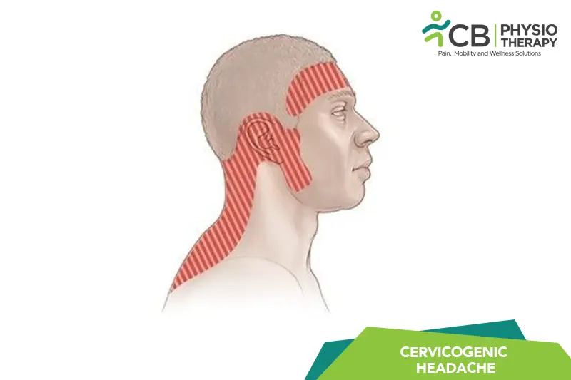 Cervicogenic Headache