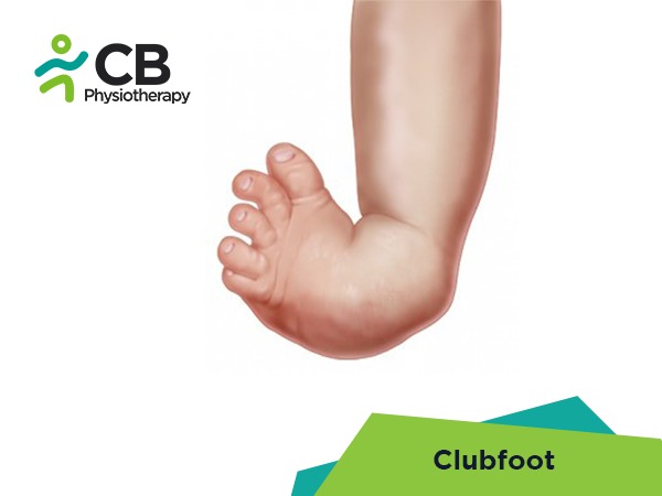 Clubfoot Or Congenital Talipes Equinovarus Or Ctev