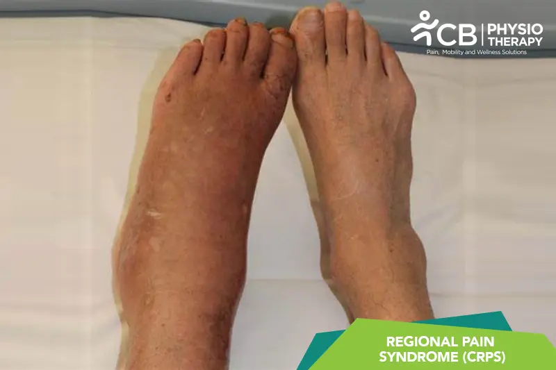 Complex Regional Pain Syndrome (crps)