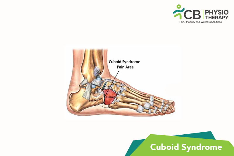 Cuboid Syndrome