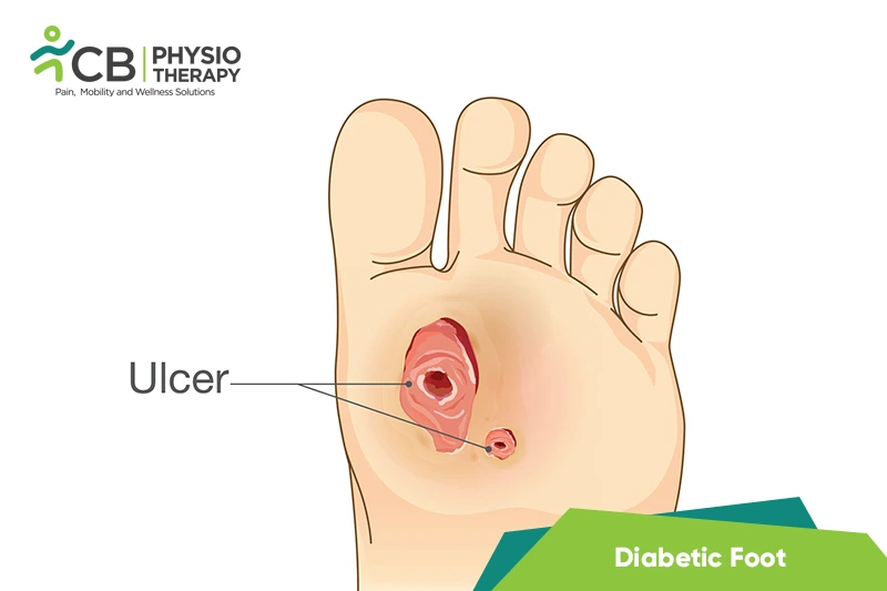 Diabetic Foot