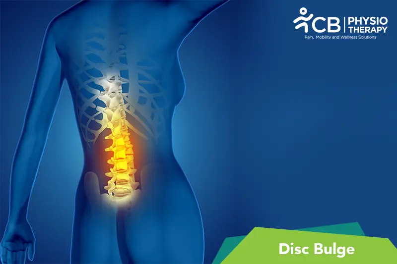Disc Bulge