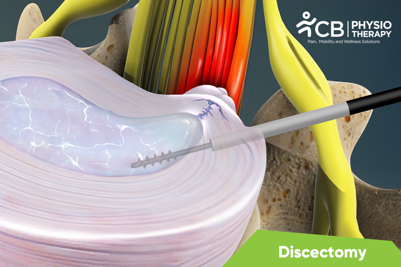 Discectomy