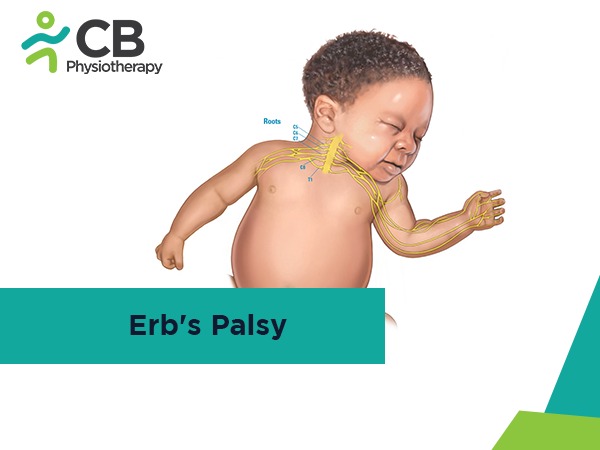 Erb’s Palsy