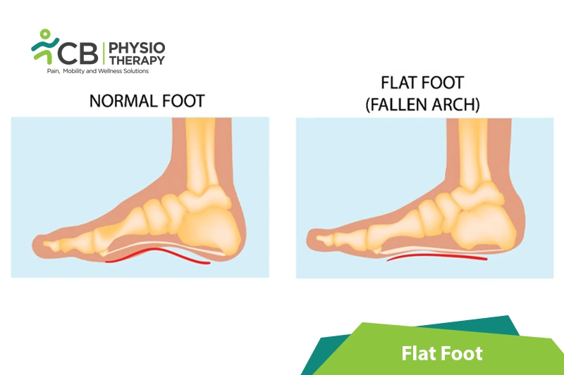 Flat Foot