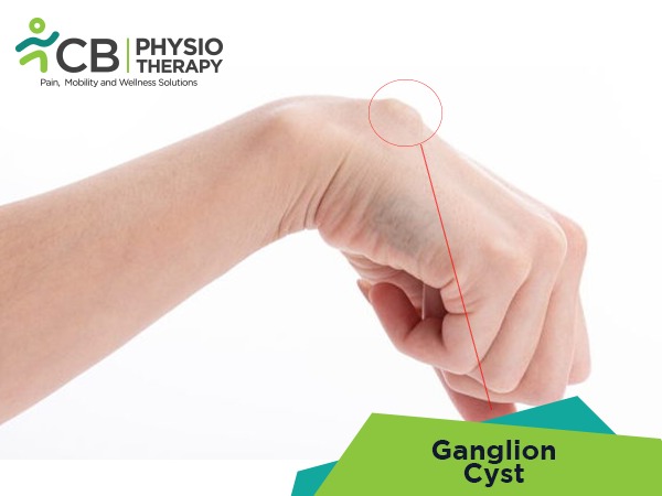 Ganglion Cyst