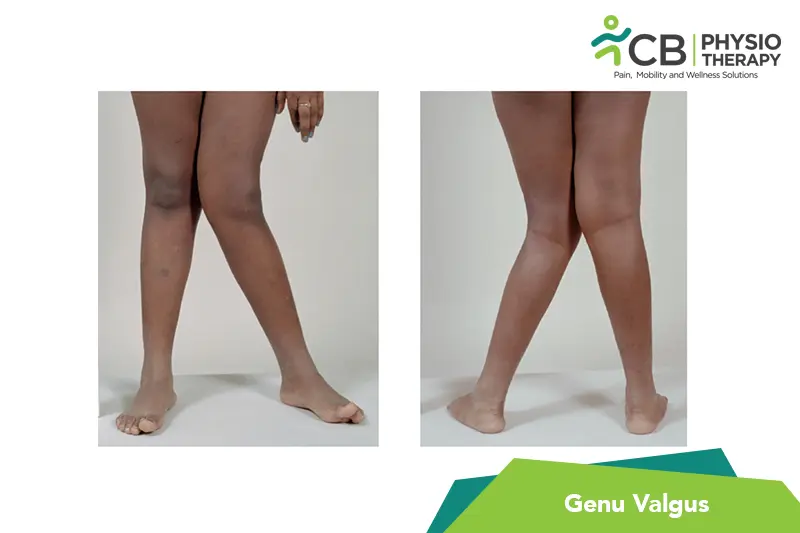 Genu Valgus