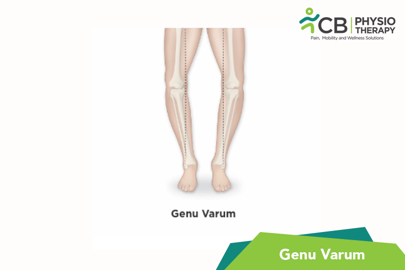 Genu Varum