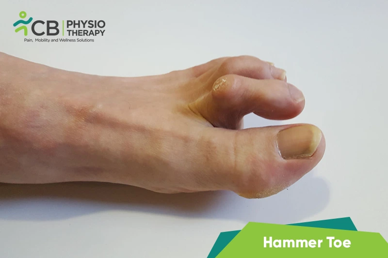 Hammer Toe