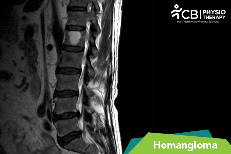 Hemangioma