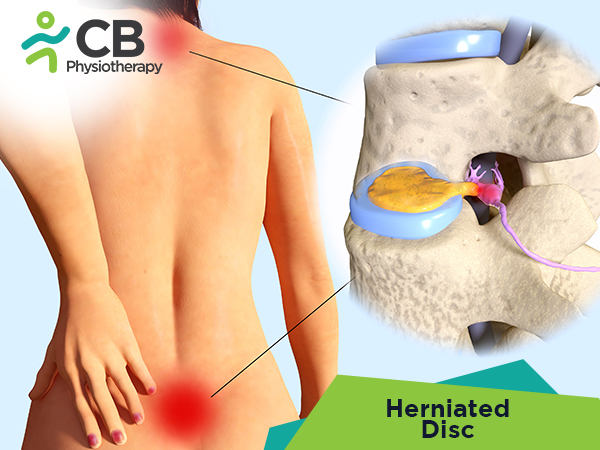 Herniated Disk Or Slipped Disc