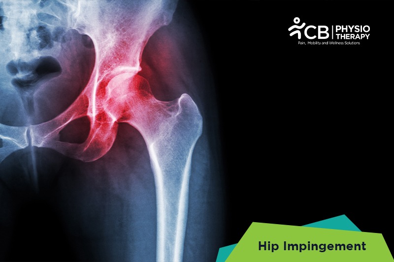 Hip Impingement