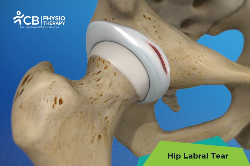 Hip Labral Tear