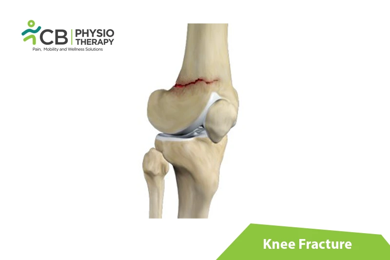 Knee Fracture