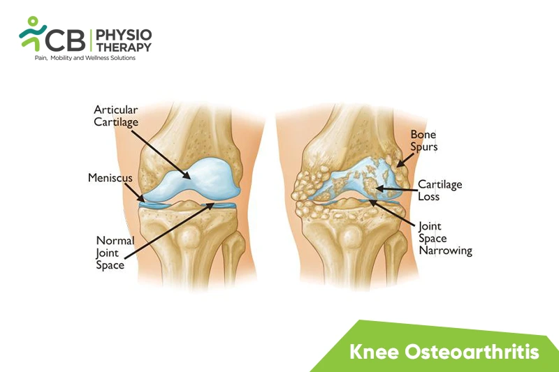 Knee Osteoarthritis