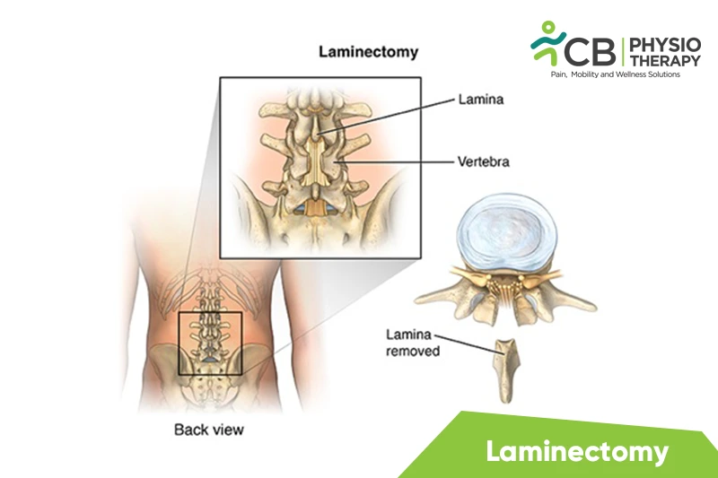 Laminectomy