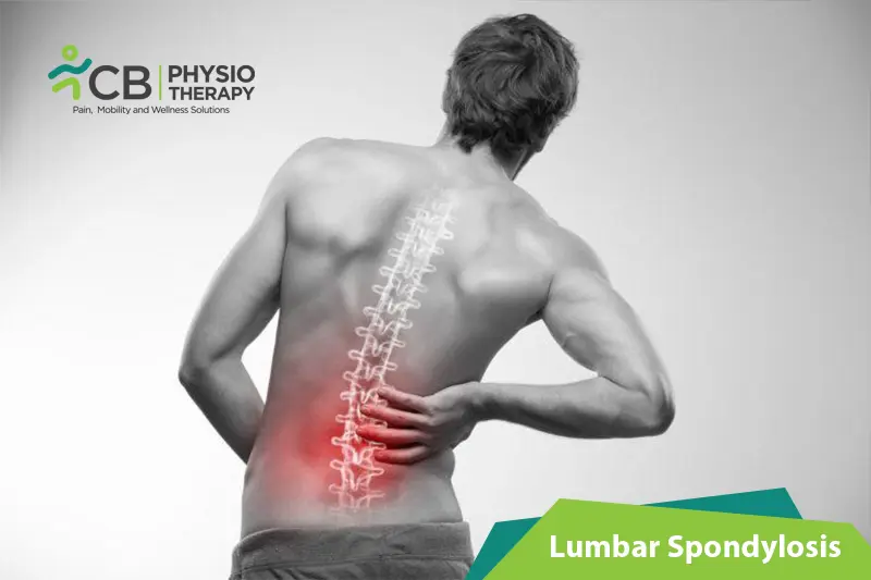 Lumbar Spondylosis