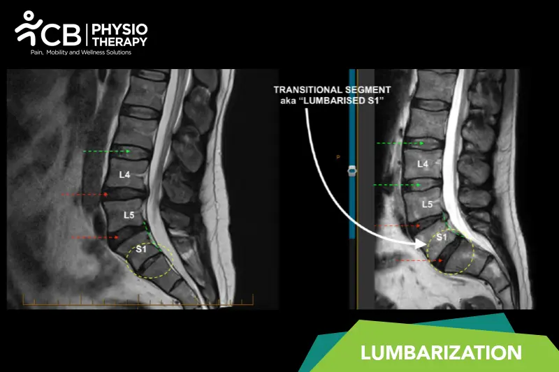 Lumbarization