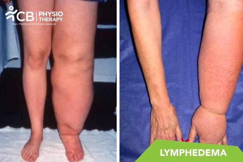 Lymphedema
