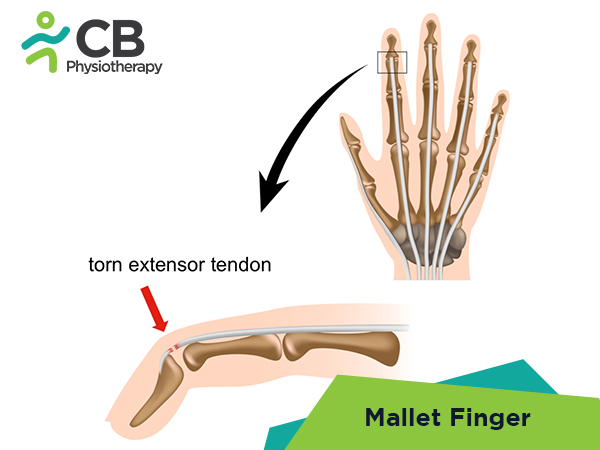Mallet Finger