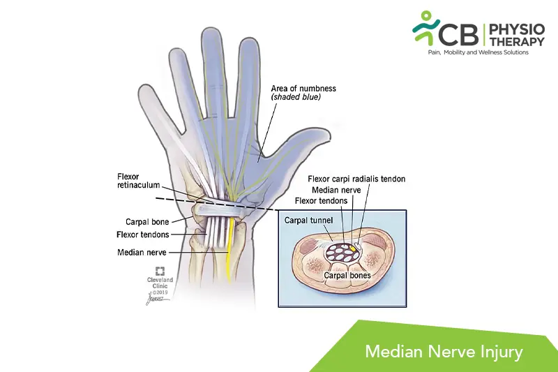 Median Nerve Injury