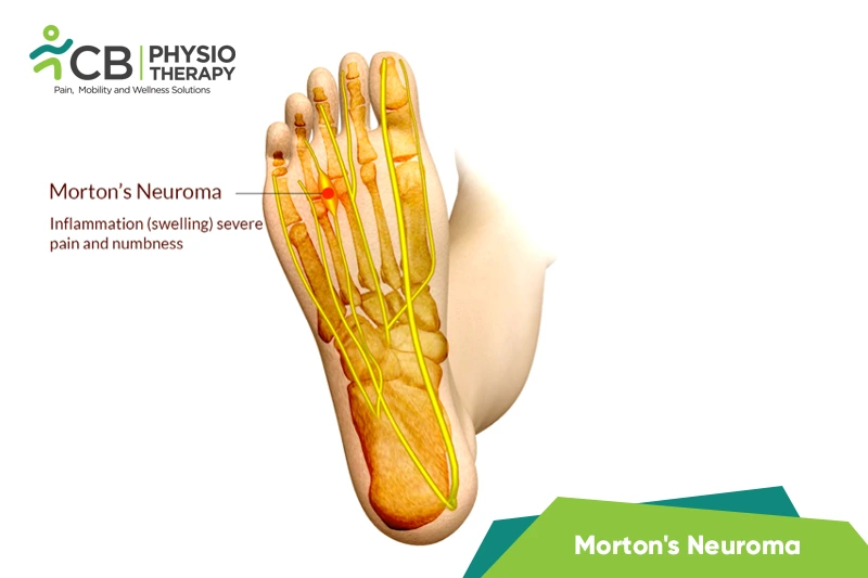 Morton's Neuroma