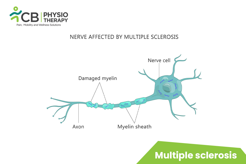 Multiple Sclerosis