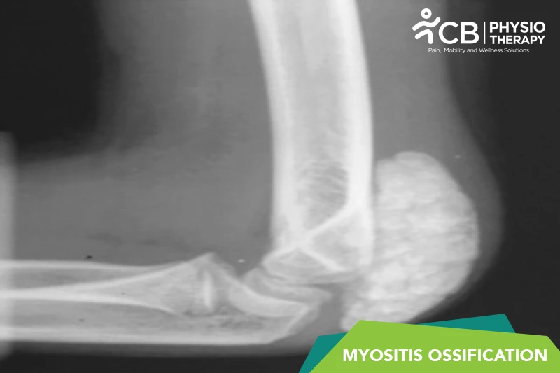 Myositis Ossification (mo)