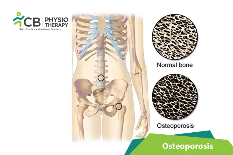 Osteoporosis