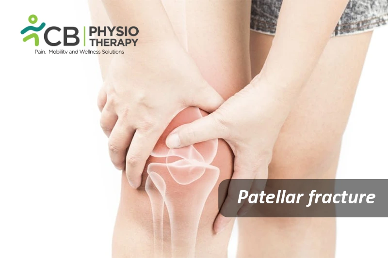 Patellar Fracture